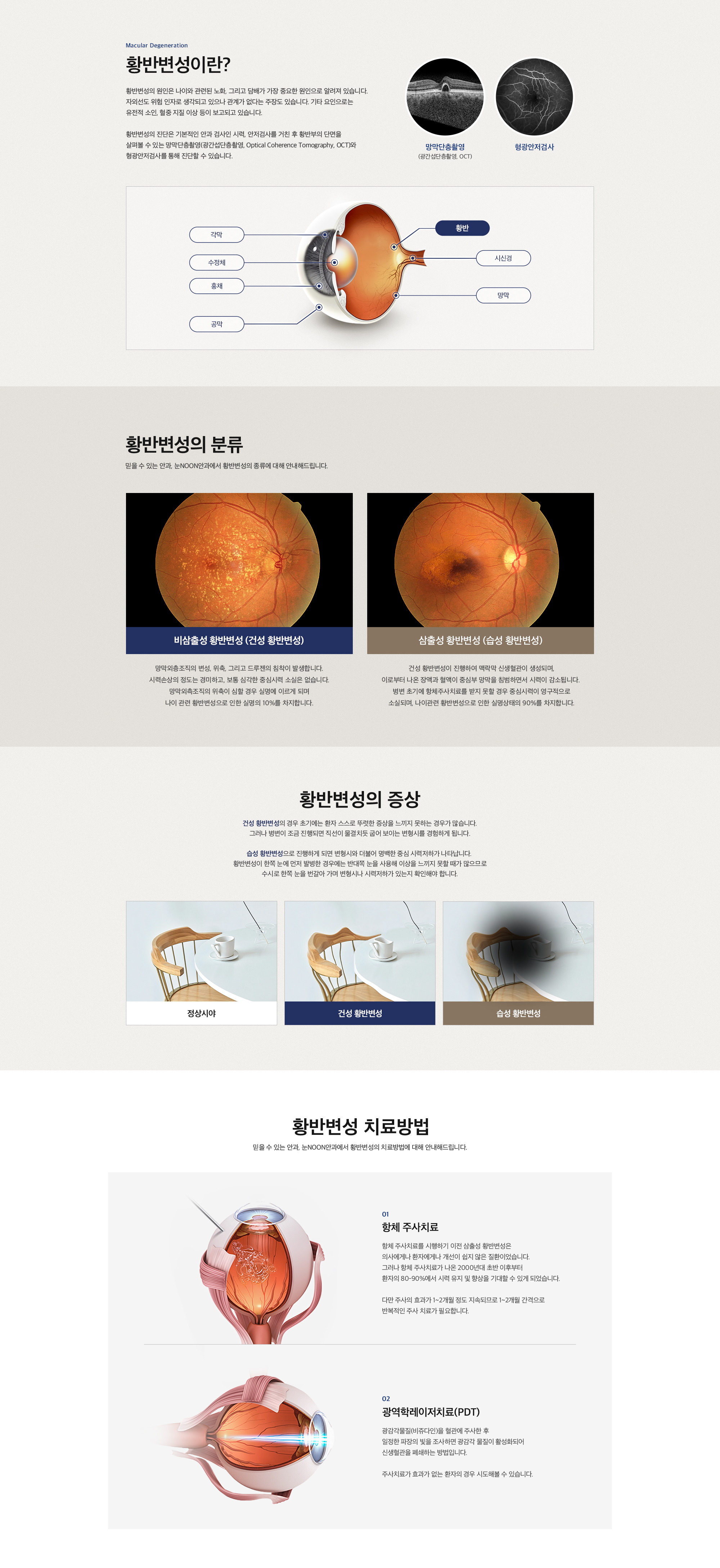 황반변성