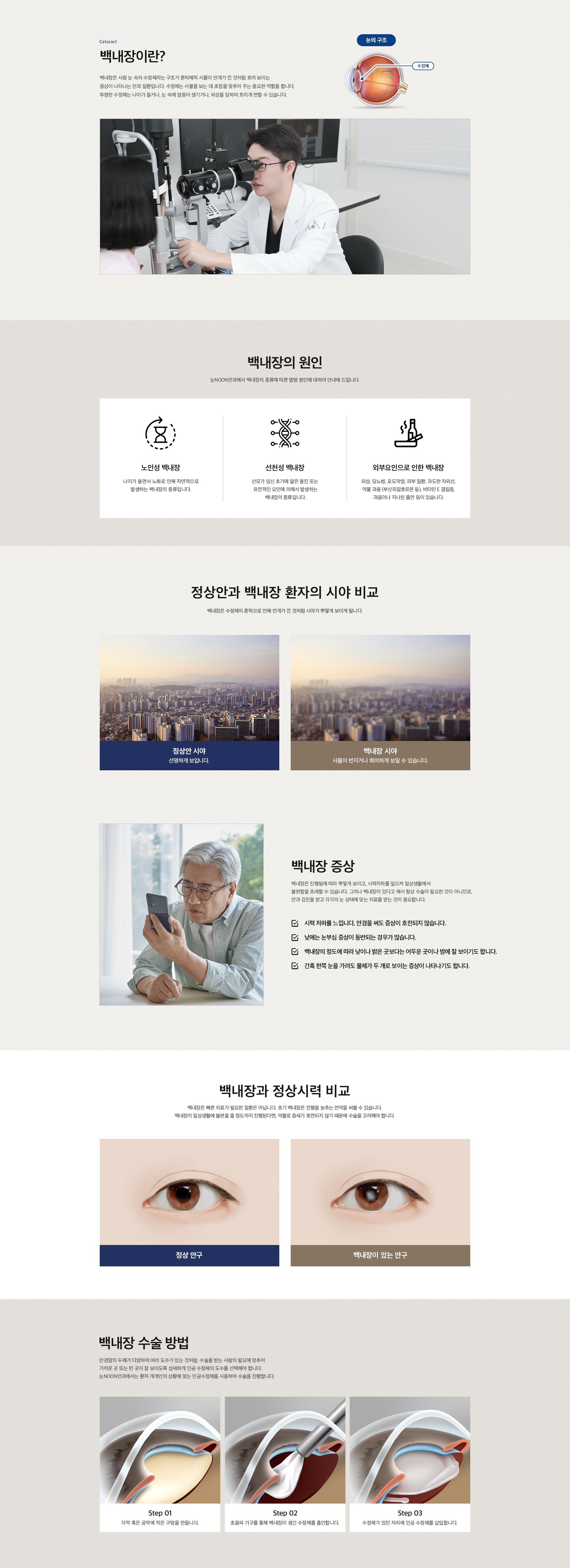 백내장이란